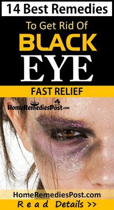 How to Get Rid of a Black Eye Fast_Top 5 Best Ways - YouTube | Health&Diet | Black eye remedies ...