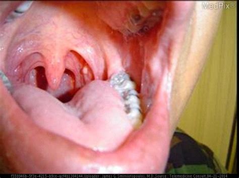 The elevated round pink area on the left tonsil appears | Open-i