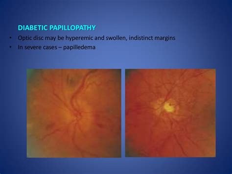 Optic disc evaluation