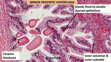 Benign Prostatic Hyperplasia (BPH) - Pathology Made Simple