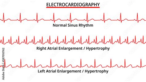 Set of ECG Common Abnormalities - Right Atrial Enlargement / Hypertrophy vs Left Atrial ...