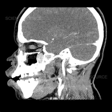 Nasopharyngeal Angiofibroma Radiology