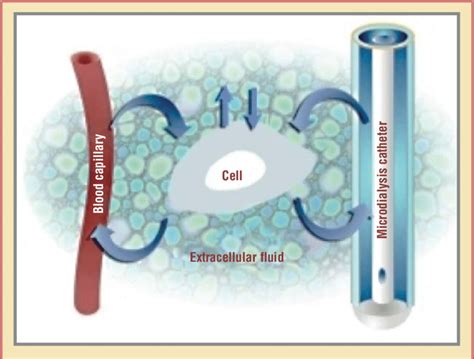 Microdialysis technique. The microdialysis catheter at the distal end ...