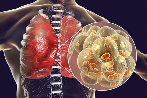 Pneumonia: What to eat and what to avoid to combat this serious ...