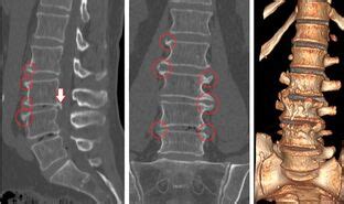 Back pain in the lumbar region needs more treatment - Hondrogel