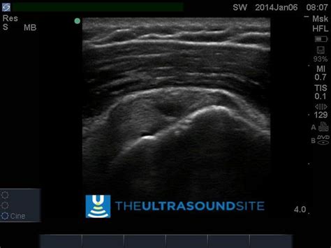 Partial articular surface tear of Supraspinatus tendon, for more resources on MSK Ultrasound ple ...