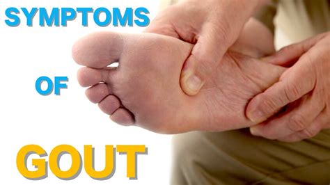 Top 10 Common Gout Symptoms Causes of Gout Symptoms of Gout - YouTube