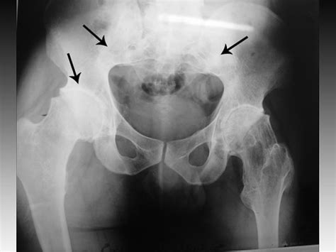 Sacroiliac Joint Erosion