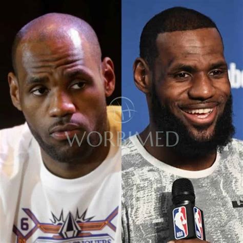 LeBron James Hair Transplant l Before and After