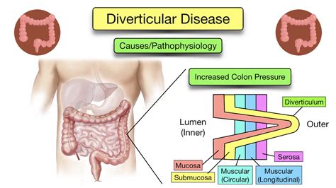 Diverticular Disease: Diverticulitis vs Diverticulosis - Symptoms, Diet ...