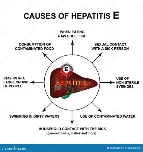 Causes Of Hepatitis E. World Hepatitis Day. Infographics. Vector ...