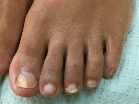 Nail Fungus - San Rafael, CA & Lower Pacific Heights San Francisco, CA: Bay Area Foot Care