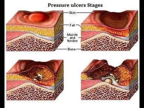 Skin Pressure Ulcer Stages