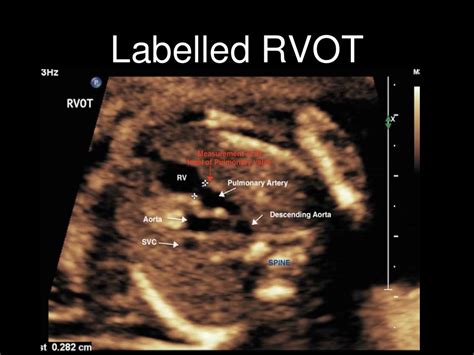 Labelled fetal heart ultrasound