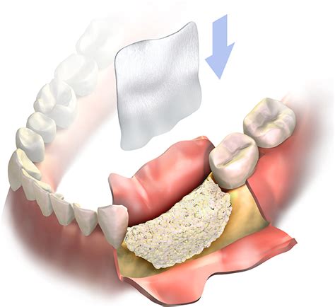 Ridge Augmentation Lee's Summit MO | Dental Bone Graft