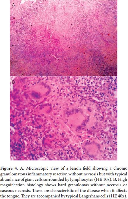 Tuberculosis Histology