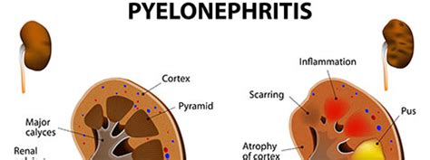 Pyelonephritis/Kidney Infection: Causes, Symptoms And Treatment