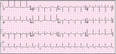 Arrhythmia masquerading as Cardiac Ischemia – Resus Review