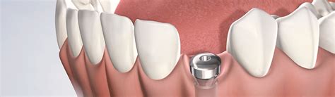 Dental Implant Procedure | Lifestyle