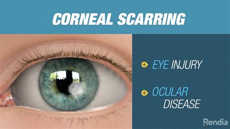 corneal scarring healing time - Captions Rotation