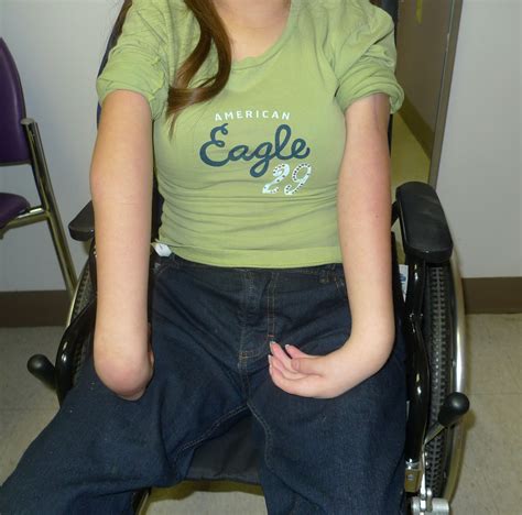 Arthrogryposis | Congenital Hand and Arm Differences | Washington University in St. Louis