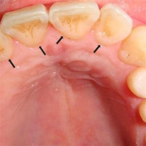 Type I shovel-shaped incisor: Trace shovel. Arrows indicate distinct... | Download Scientific ...