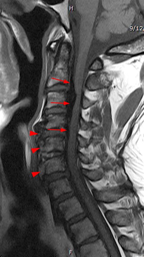 Ligament Of Treitz X Ray / The Radiology Assistant : Shoulder Anatomy ...