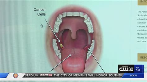 LOCAL HEALTH ALERT: HPV directly related to Throat Cancer; doctors urge vaccination ...