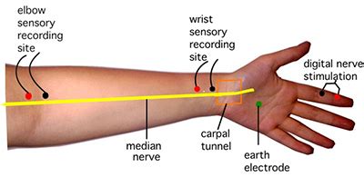 Testing For Carpal Tunnel | The Carpal Solution