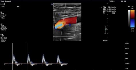 Right lower extremity venous and arterial duplex ultrasound on day 5 of... | Download Scientific ...