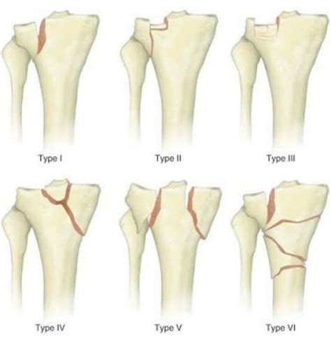 SCHATZKER CLASSIFICATION FOR TIBIA PLATE FRACTURES | Tibial plateau ...