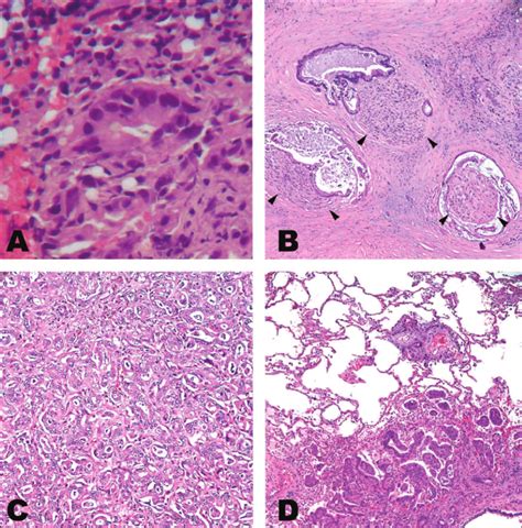 Histologic Analyses Of The Pancreatic Tumor A The Ct Guided | My XXX ...