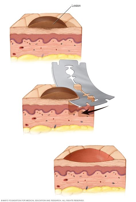 Biopsia Dibujo