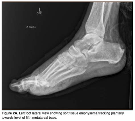 Chopart Amputation, a Viable Alternative for Non-Ambulatory Patients | Podiatry Today