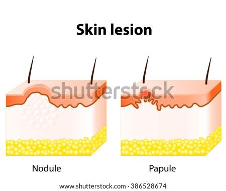 Papule Nodule Skin Lesion Stock Illustration 386528674 - Shutterstock