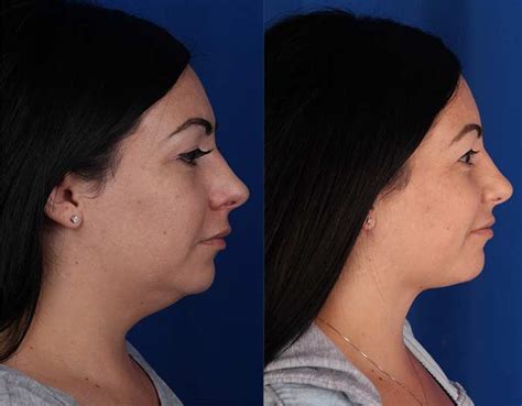 Chin Lipo Photo Gallery | Contour Dermatology