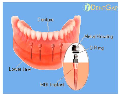 Dental Implants Reviews - Dental News Network