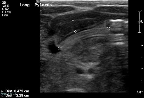 Pyloric Stenosis Ultrasound