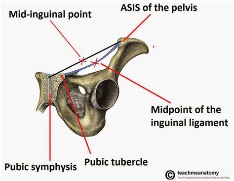 Inguinal Hernia in Egypt | Wemedical