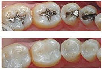 Composite & Amalgam Fillings | dental