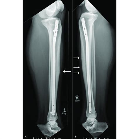 | Lateral x-ray of left (A) and right (B) tibia and fibula. | Download ...