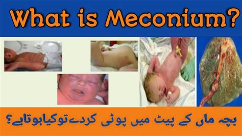 Baby stool pass inside womb/Baby poti/what is Meconium/Meconium Aspiration syndrome ...