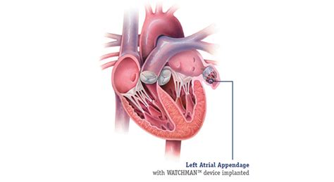 Left atrial appendage closure: A life-changing procedure for patients with nonvalvular A-fib ...