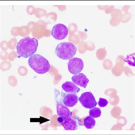 The peripheral blood smear reveals marked leukocytosis with predominant... | Download Scientific ...