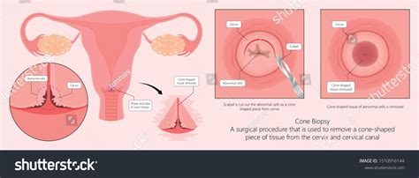 22 Cone Biopsy Images, Stock Photos & Vectors | Shutterstock