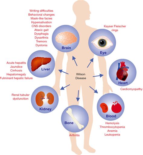 Wilson Disease