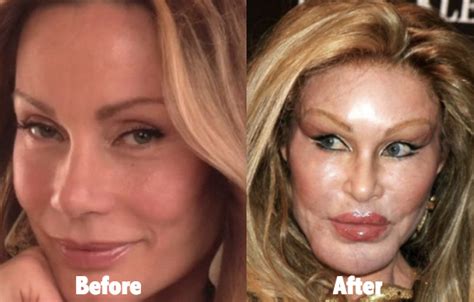 Jocelyn Wildenstein Plastic Surgery Before And After Photos