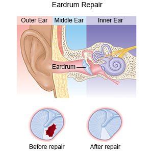 Myringoplasty and Tympanoplasty - What You Need to Know