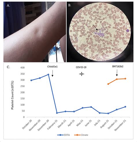 | Skin edema, platelet aggregates on the EDTA blood smear, and platelet ...