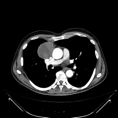 Thymoma - smooth anterior mediastinal mass, with mixed internal density of containing both ...